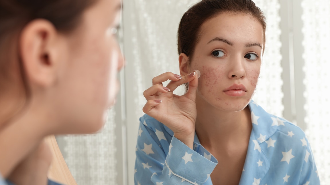 How to Choose the Best Products for Acne Scars - BeBeautiful