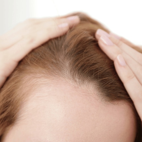 Causes of balding and solutions for restoring hairlines after the pandemic