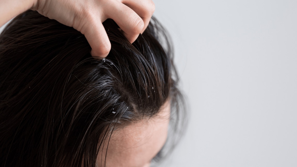 Natural home ingredients for dry scalp remedies