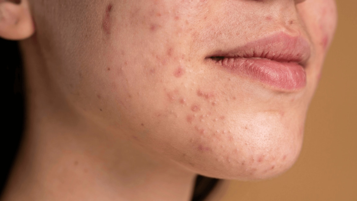 Step-by-step tips for removing pimple marks naturally