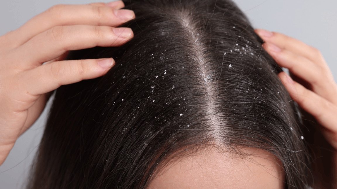 Effective home remedies to treat dandruff and a flaky scalp