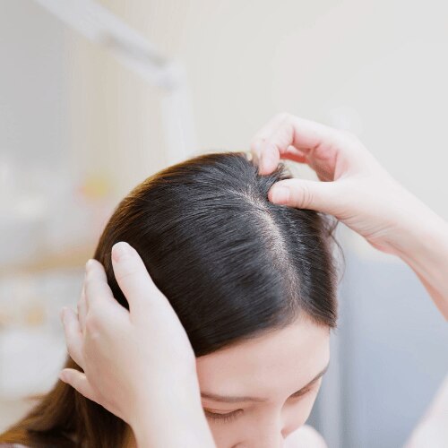 SUFFERING FROM SCALP ACNE? HERE ARE 5 HOME REMEDIES TO TRY ASAP