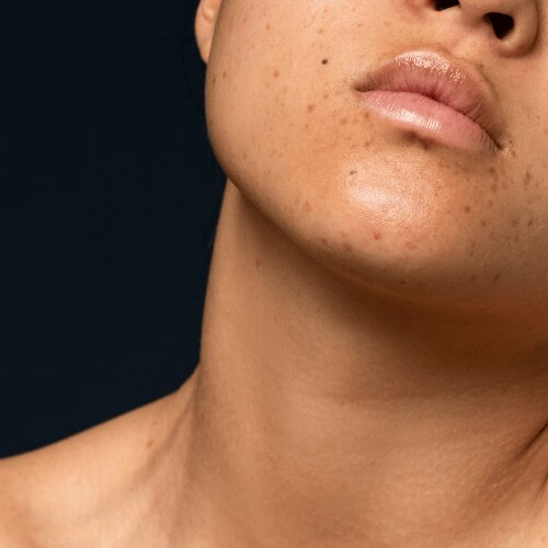 HYPERPIGMENTATION ON CHIN: CAUSES, TREATMENTS & HOW TO GET RID OF DARK CHIN NATURALLY