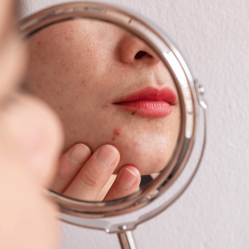 How to remove acne scars naturally at home