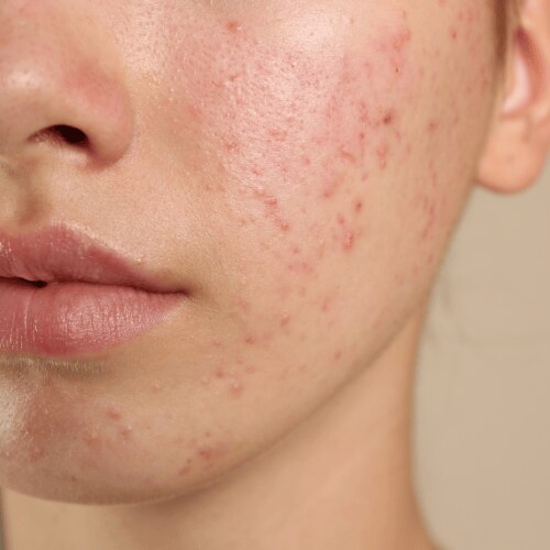 Skin Care Routine for Pimples  As Approved by Experts 