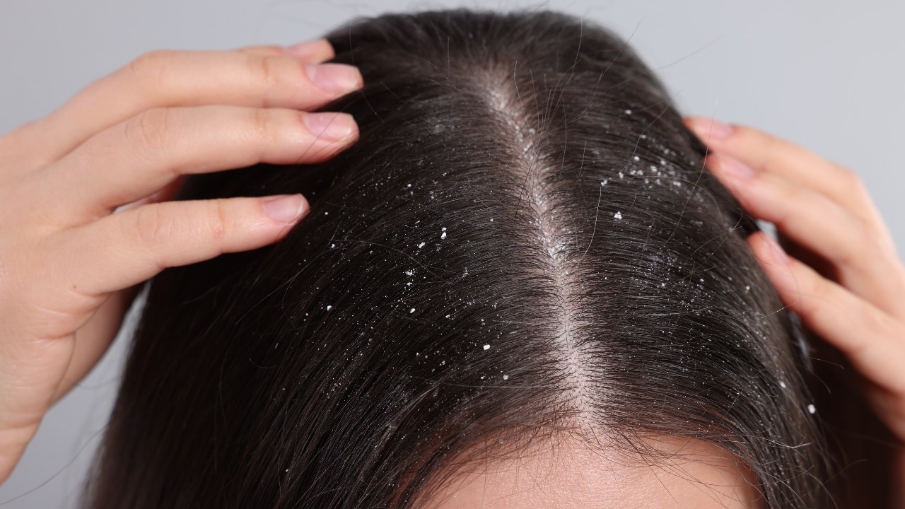 Reduces dandruff