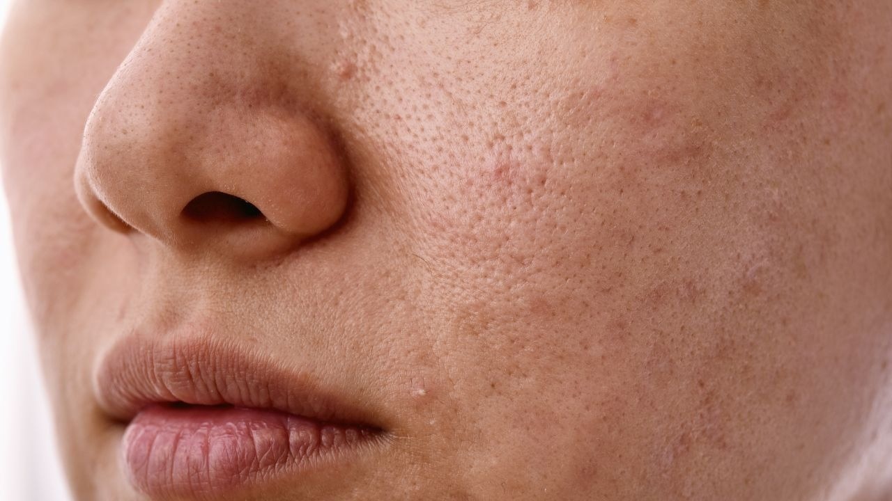 What are the common side effects of laser hair removal?