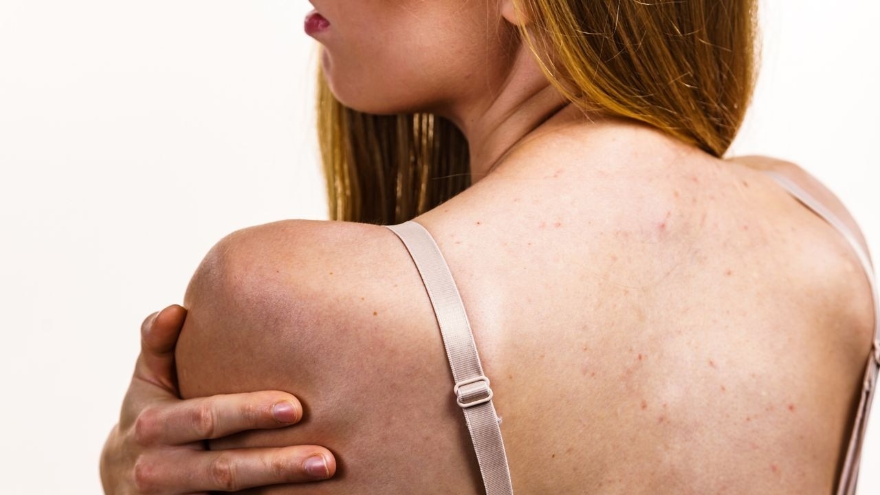 What are the common side effects of laser hair removal?