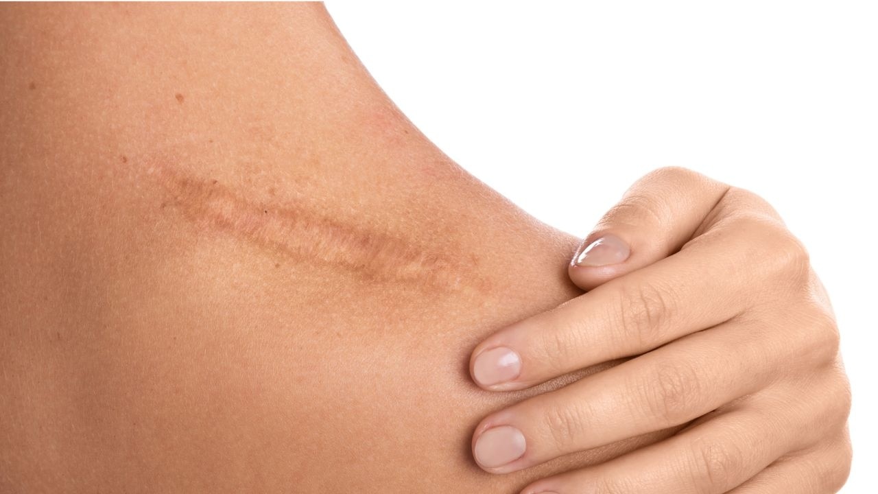 What are the common side effects of laser hair removal?