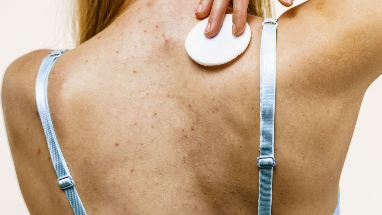 How to identify fungal acne