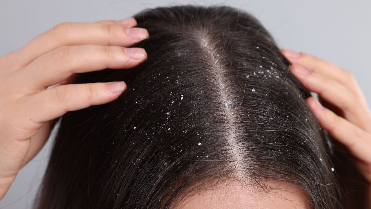 Neem oil cures dandruff
