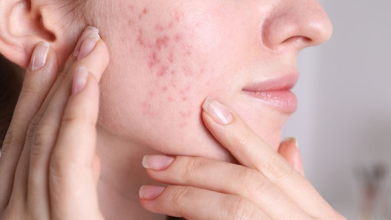 How to Know If Eggs Are Causing Acne on Your Face