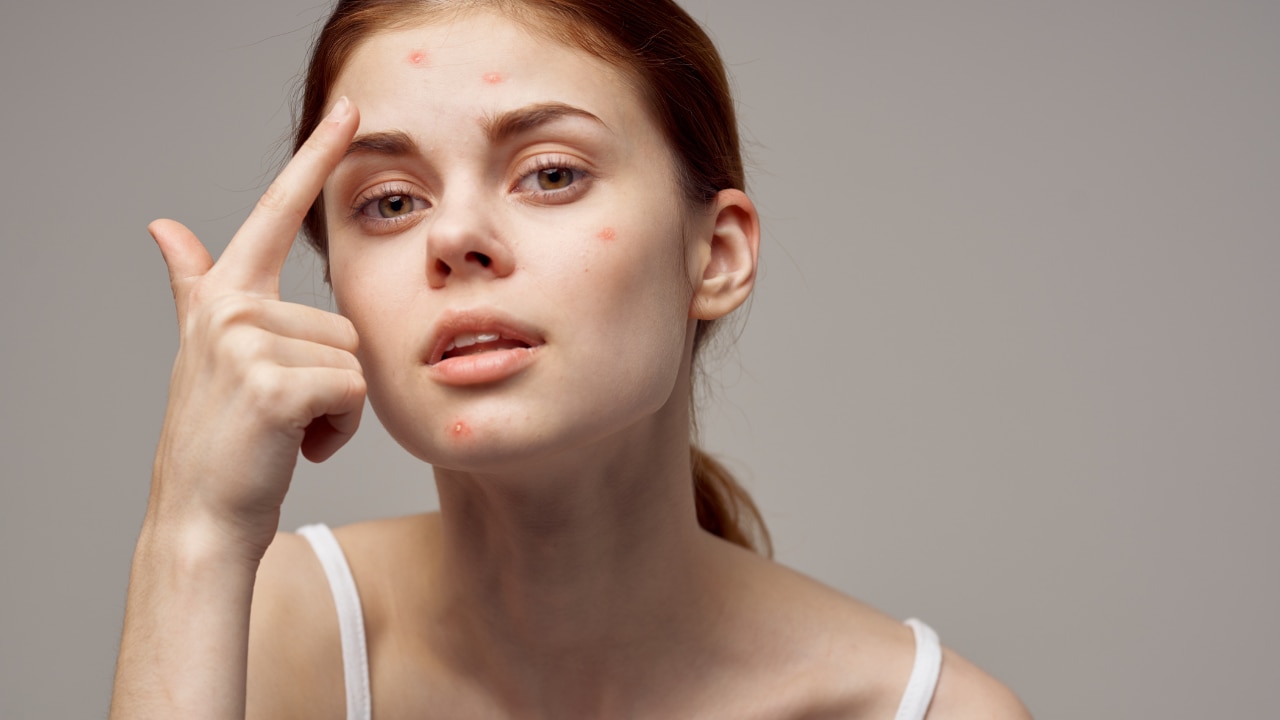 Can pimples and acne make your skin feel itchy