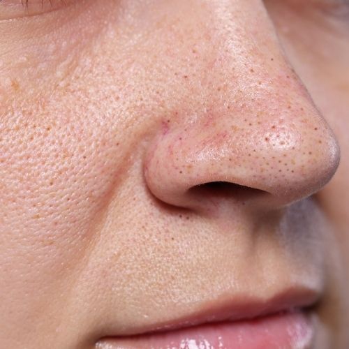 How to Remove Blackheads: Say Goodbye to Stubborn Spots With These Simple Steps