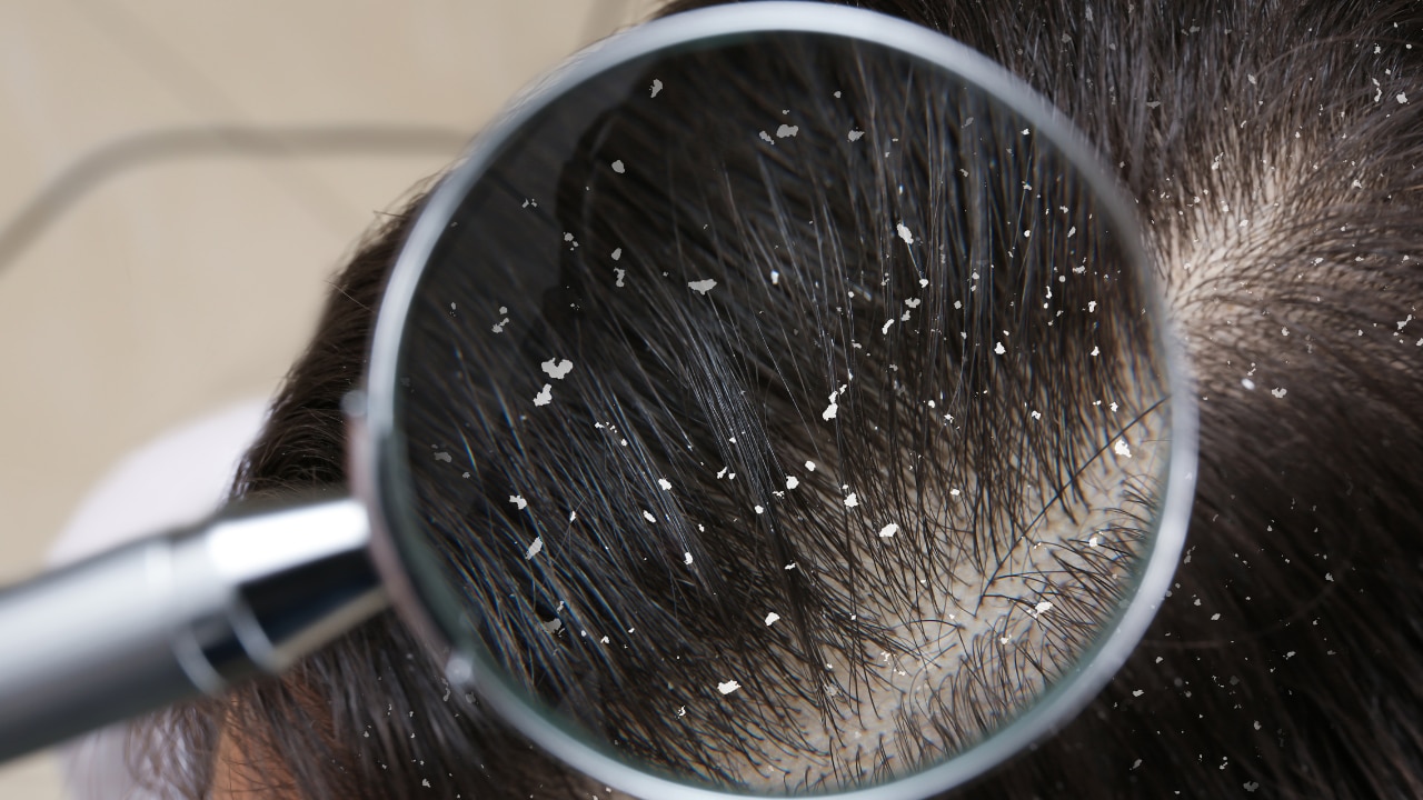 Keeps dandruff and itchy scalp at bay
