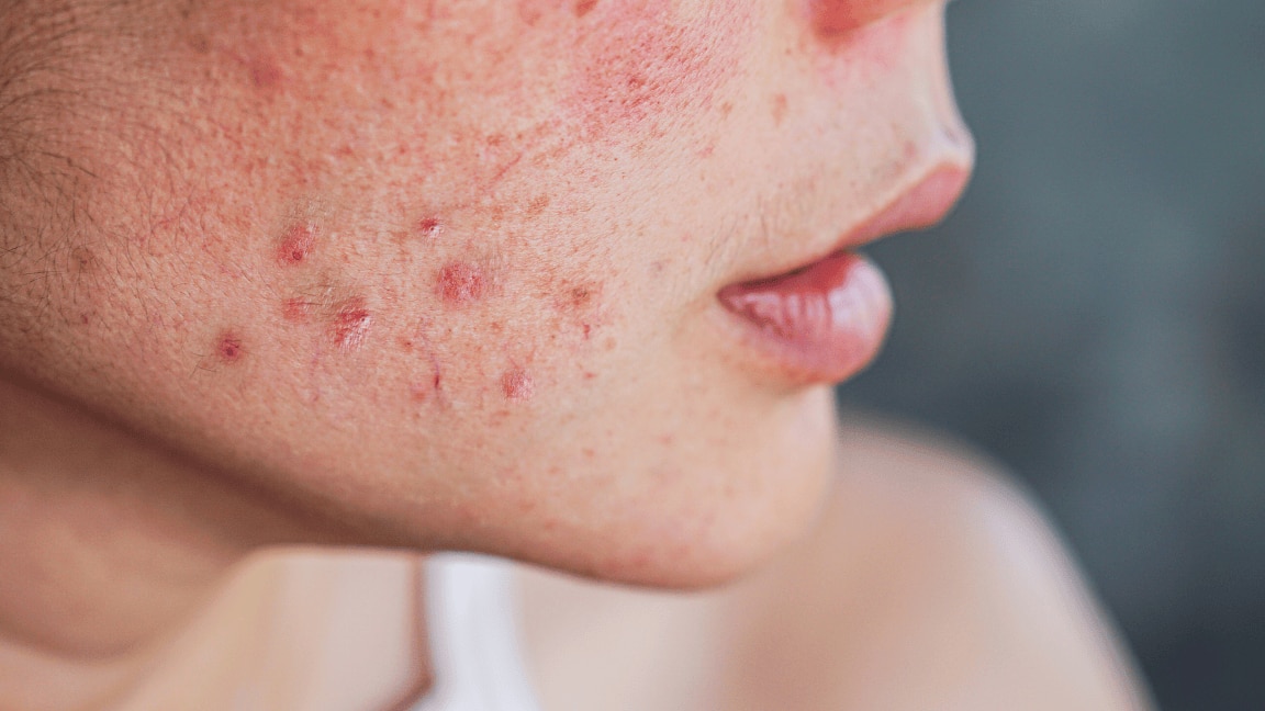 How To Remove Blemishes Fast: 10 Home Remedies To Remove Blemishes