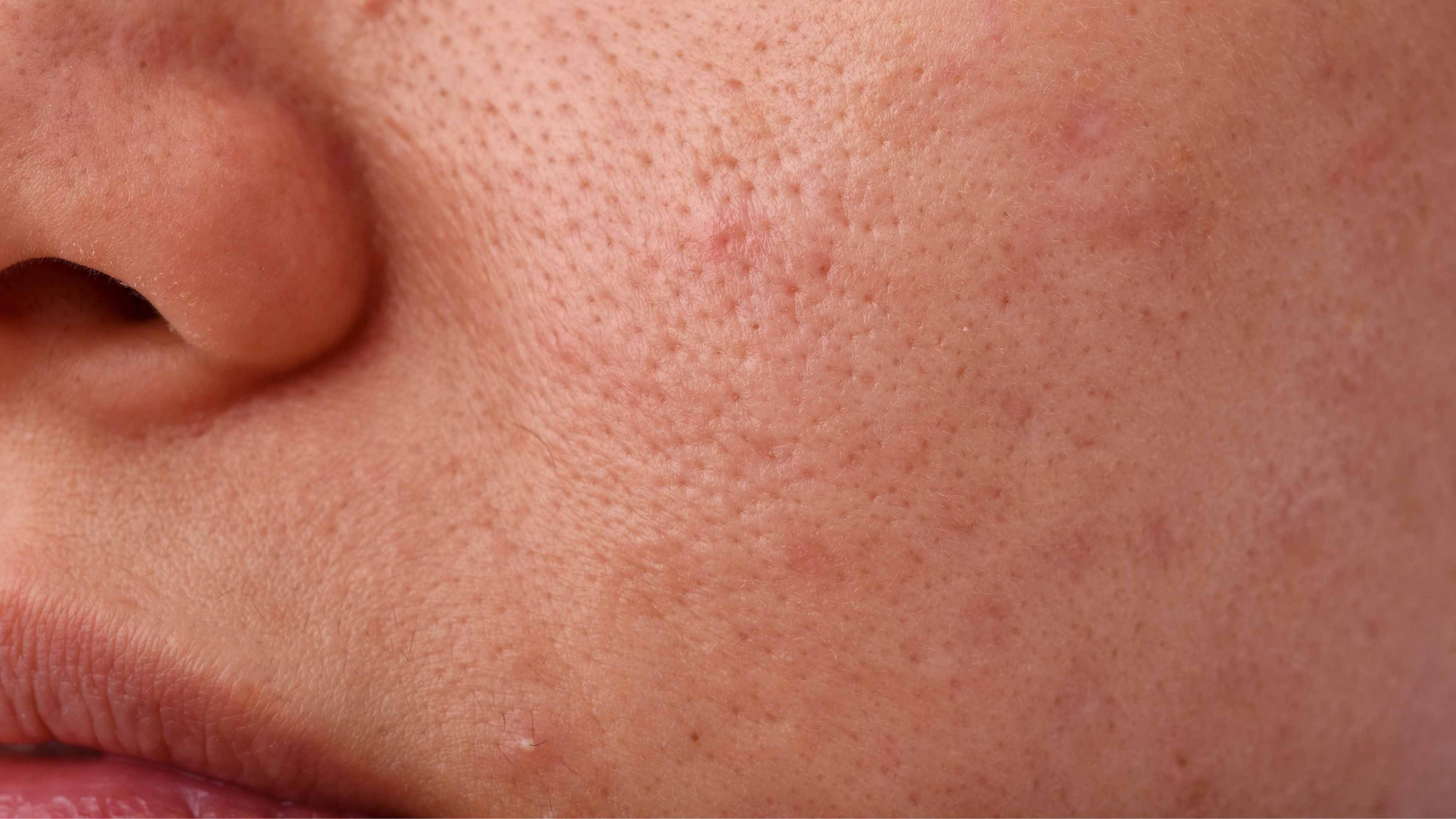 Minimises Pores
