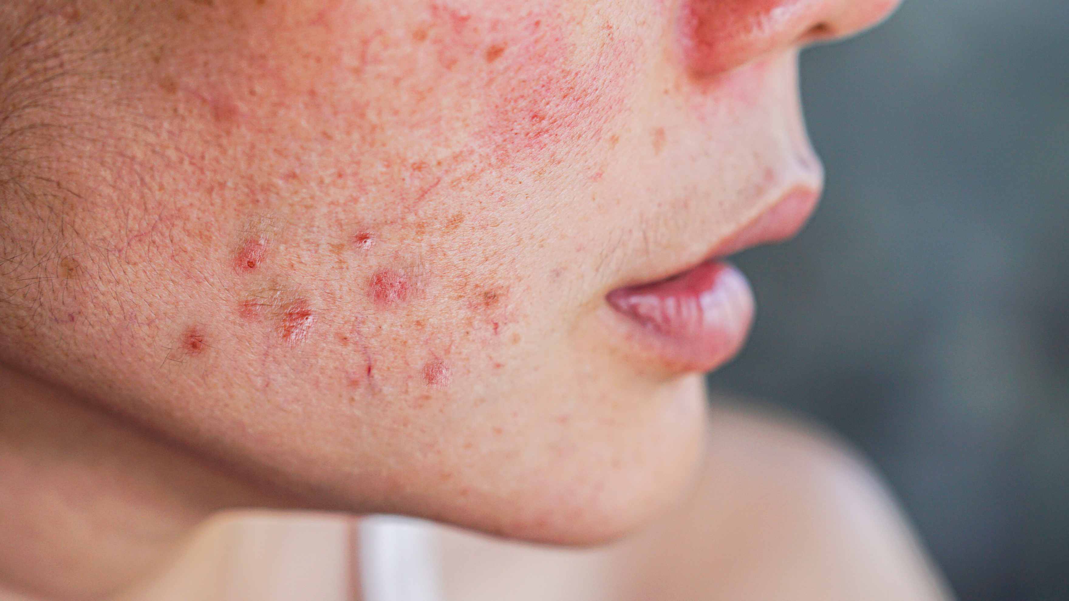Minimizes skin inflammation