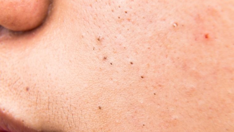 Prevents blackheads and whiteheads