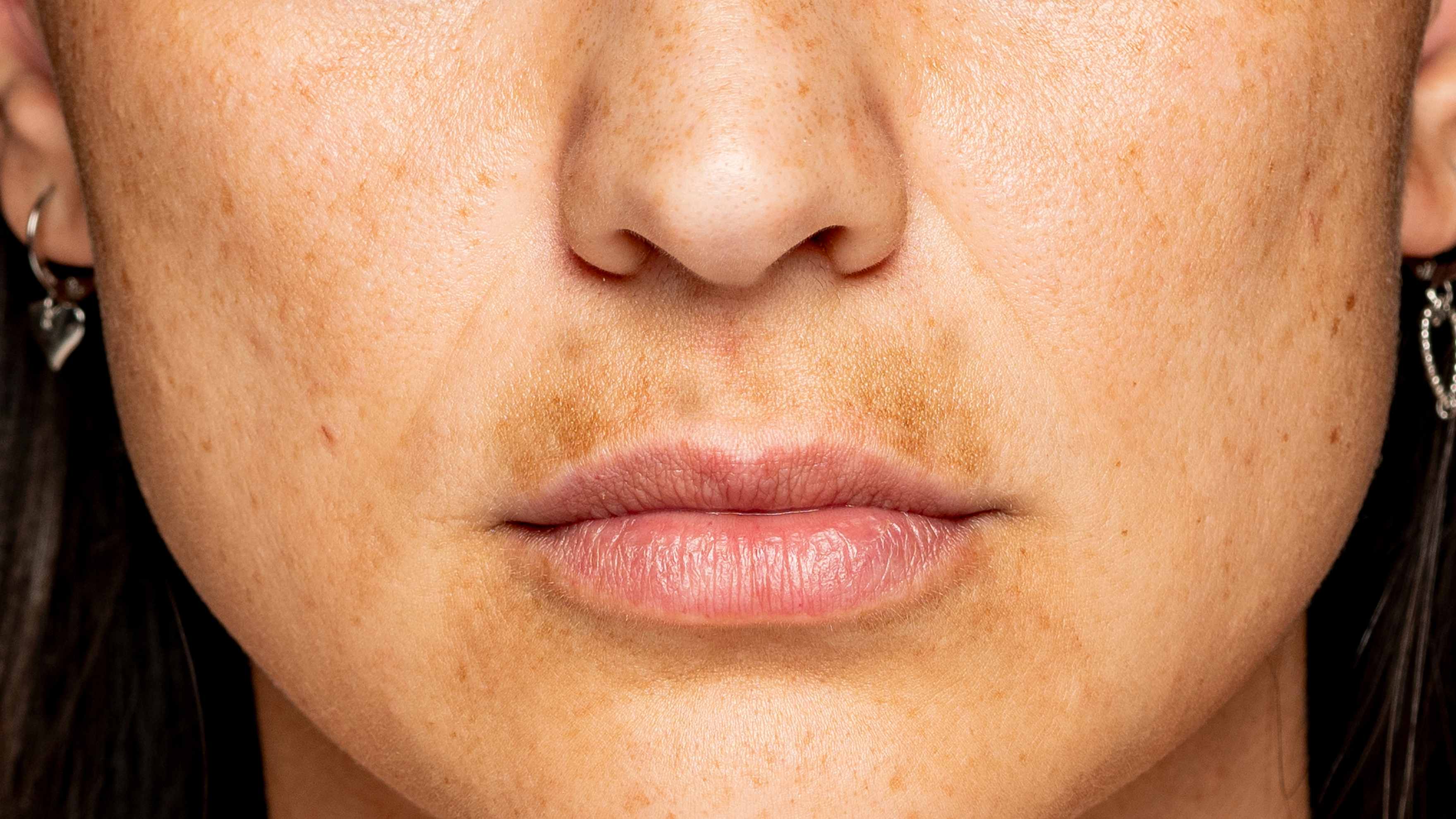 Reduces discolouration