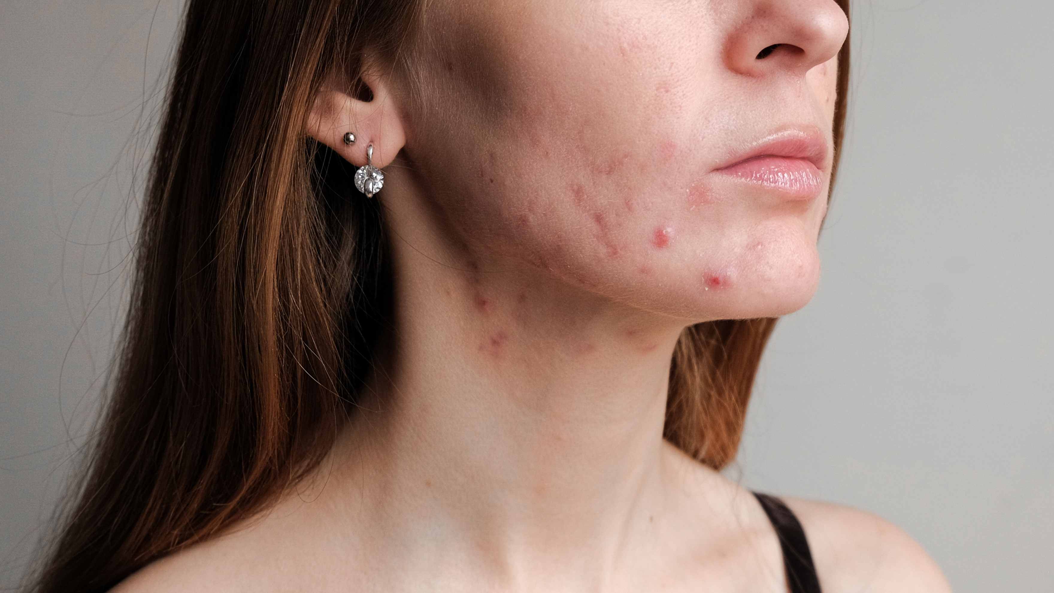 Treats acne