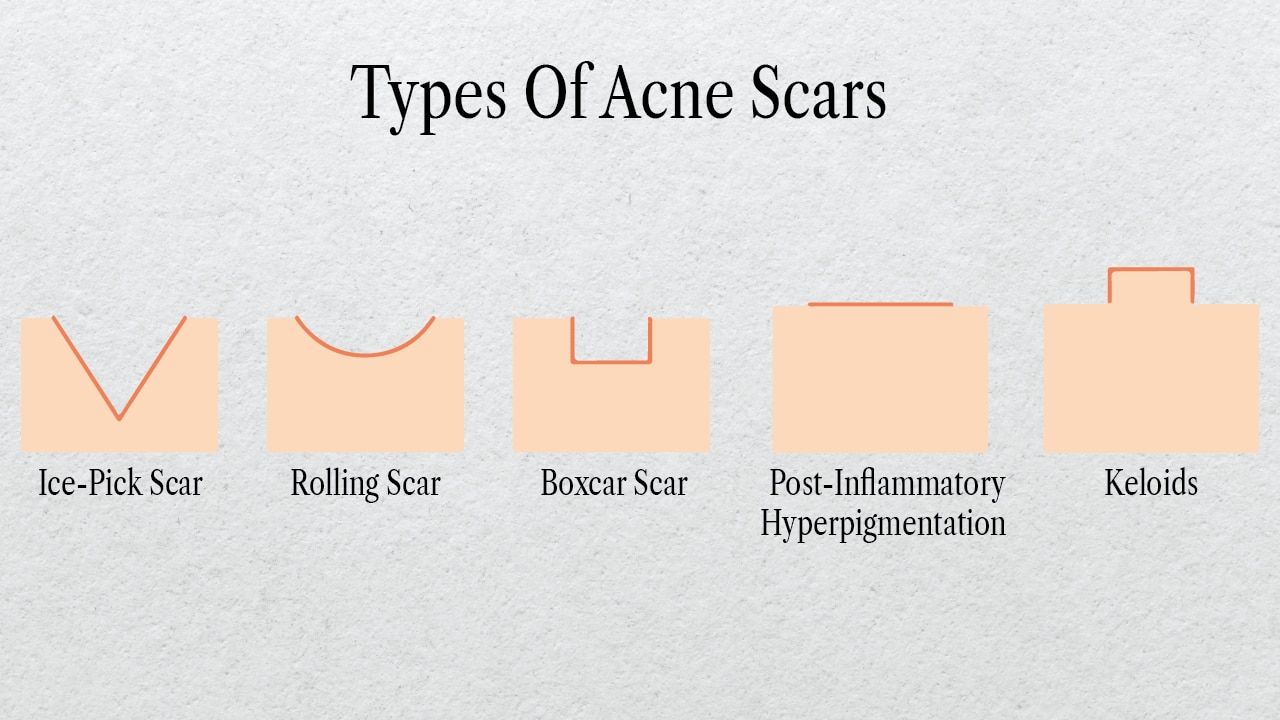 Types of pimple marks