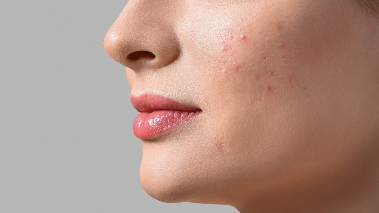 What Are Blemishes? What Causes Blemishes?