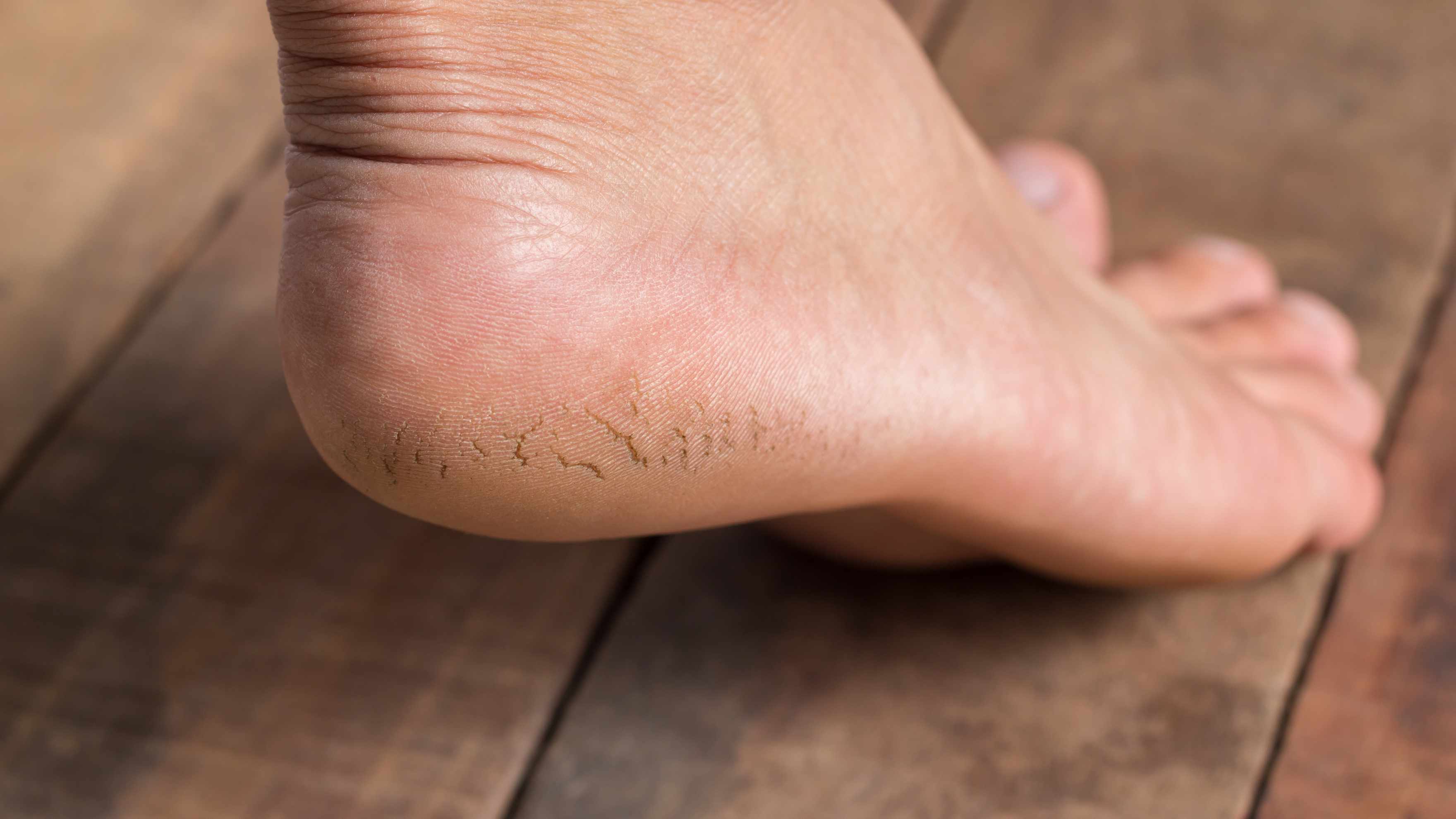 What Causes Dry and Cracked Feet