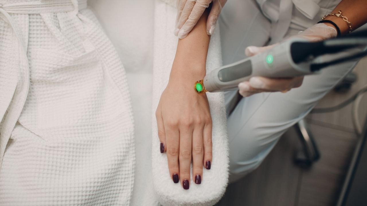What are the common side effects of laser hair removal?
