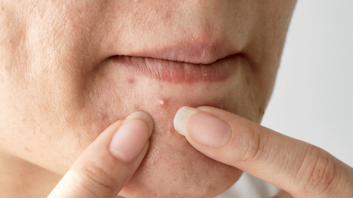 Do Eggs Cause Acne? Here Are 3 Reasons That Answer Your Question