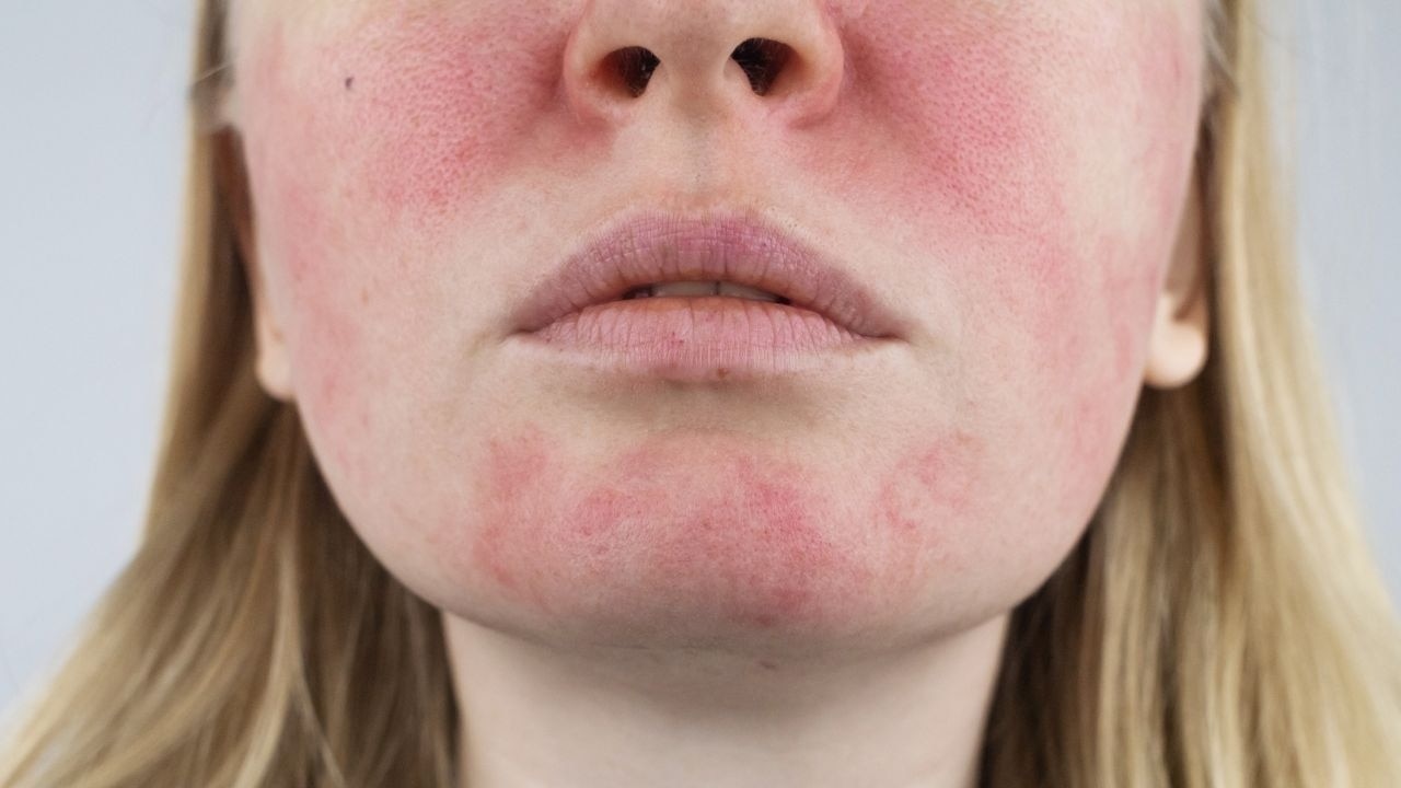What are the common side effects of laser hair removal?