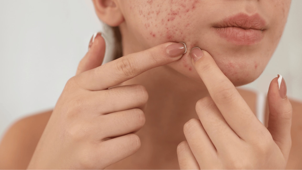 How To Remove Pimple Marks Naturally At Home