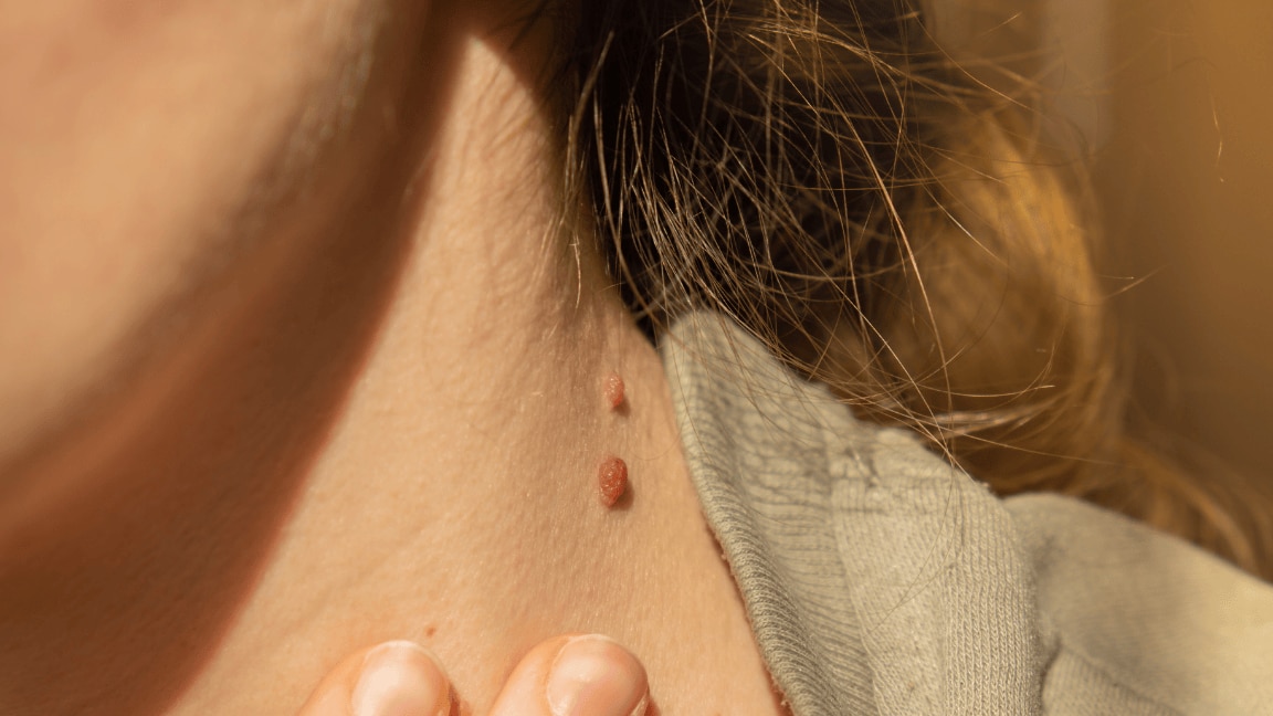 Home Remedies for skin Tags