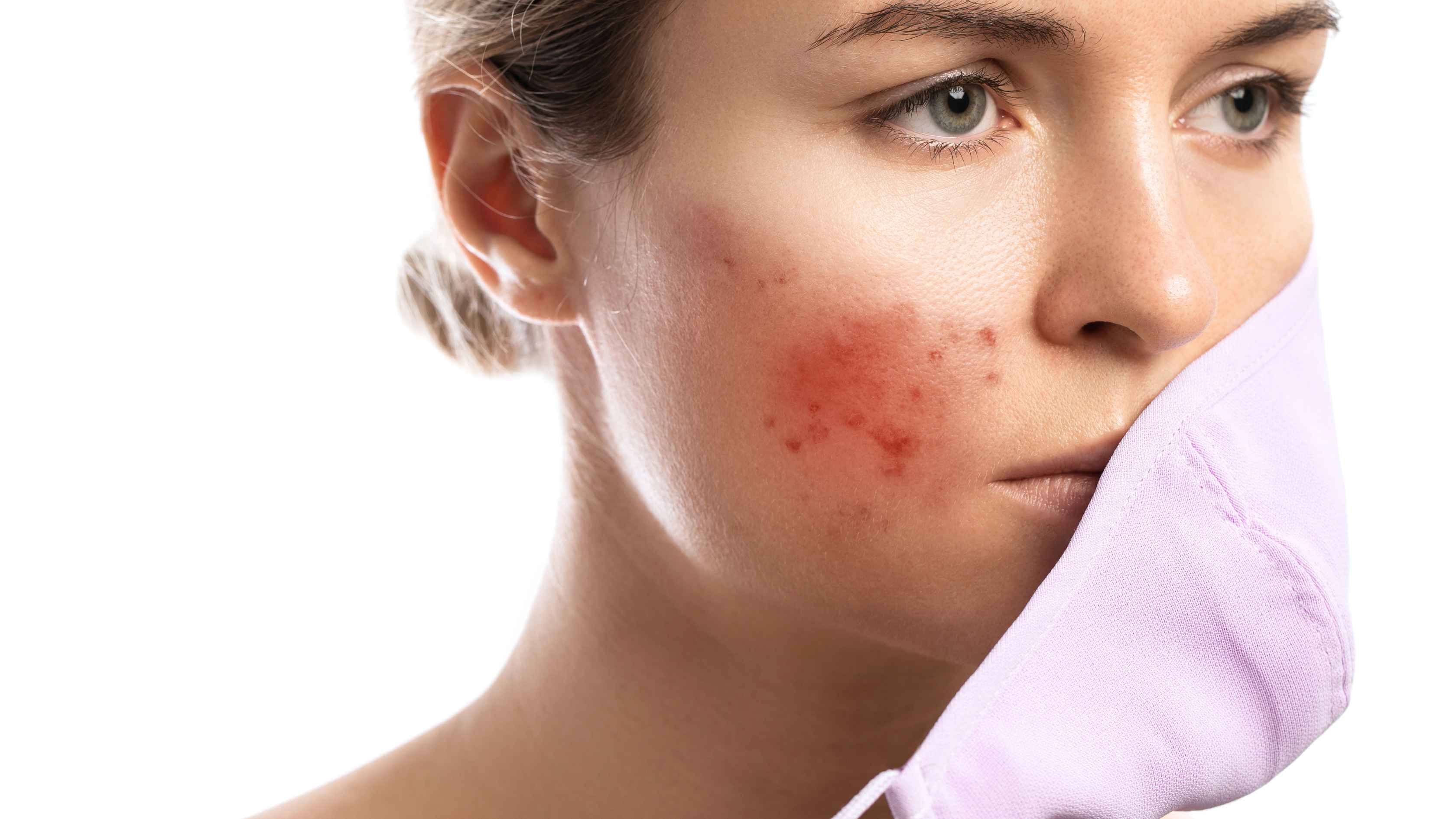 Reduces excess oil and acne