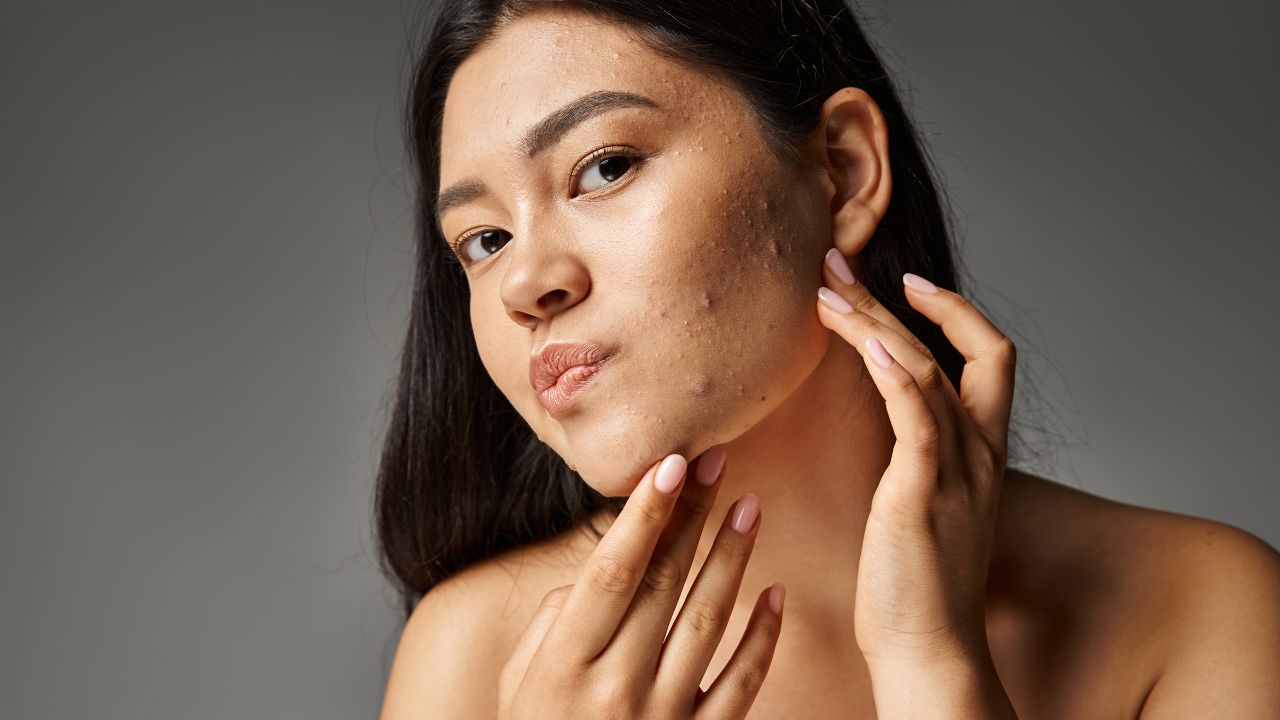 - Reduces and prevents acne
