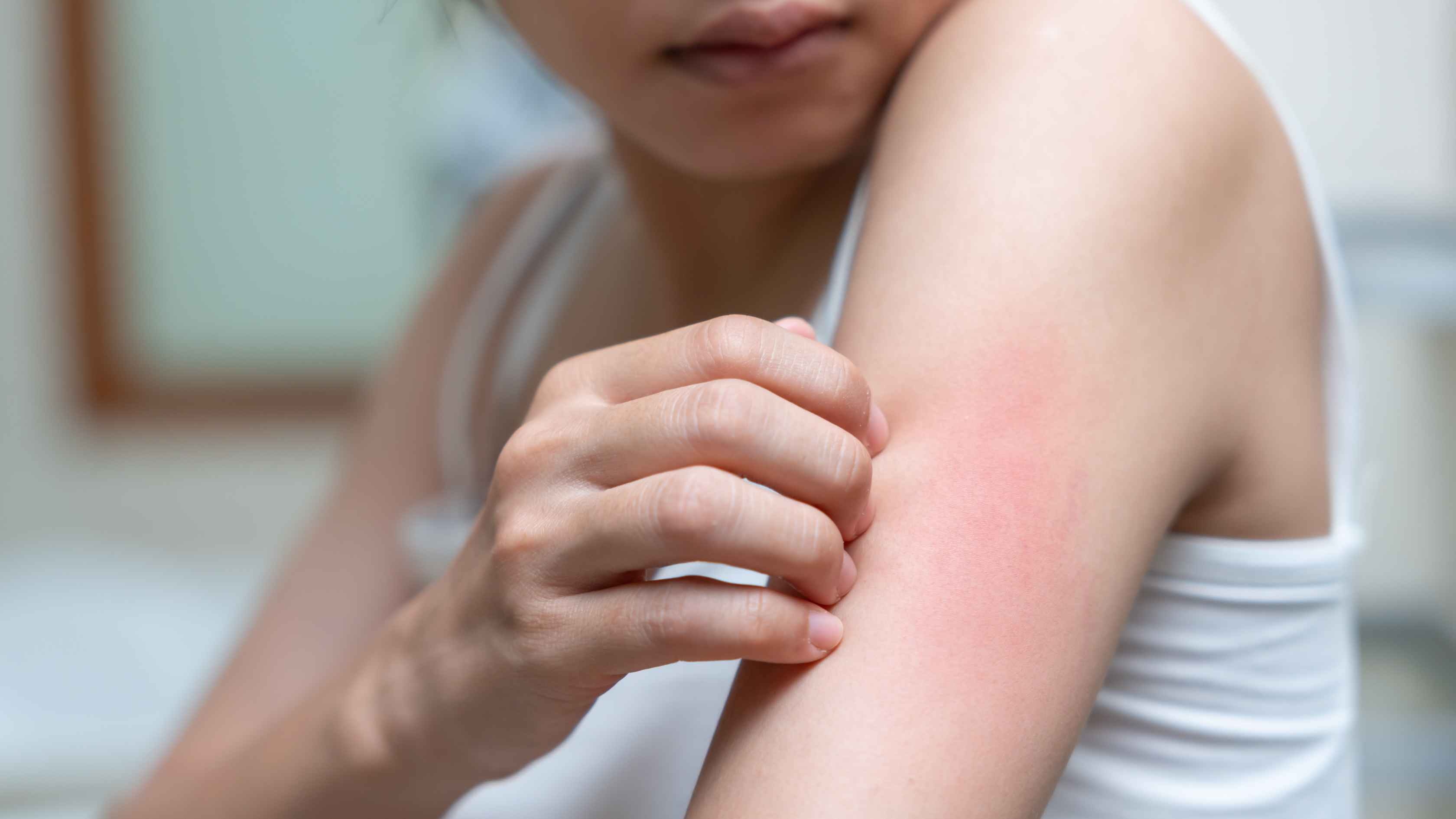 Calms skin irritation