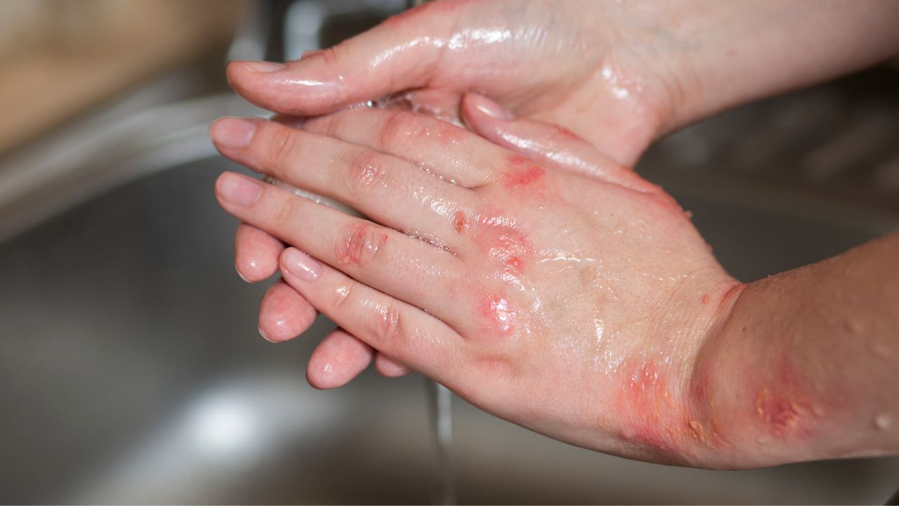 - Treats psoriasis and eczema