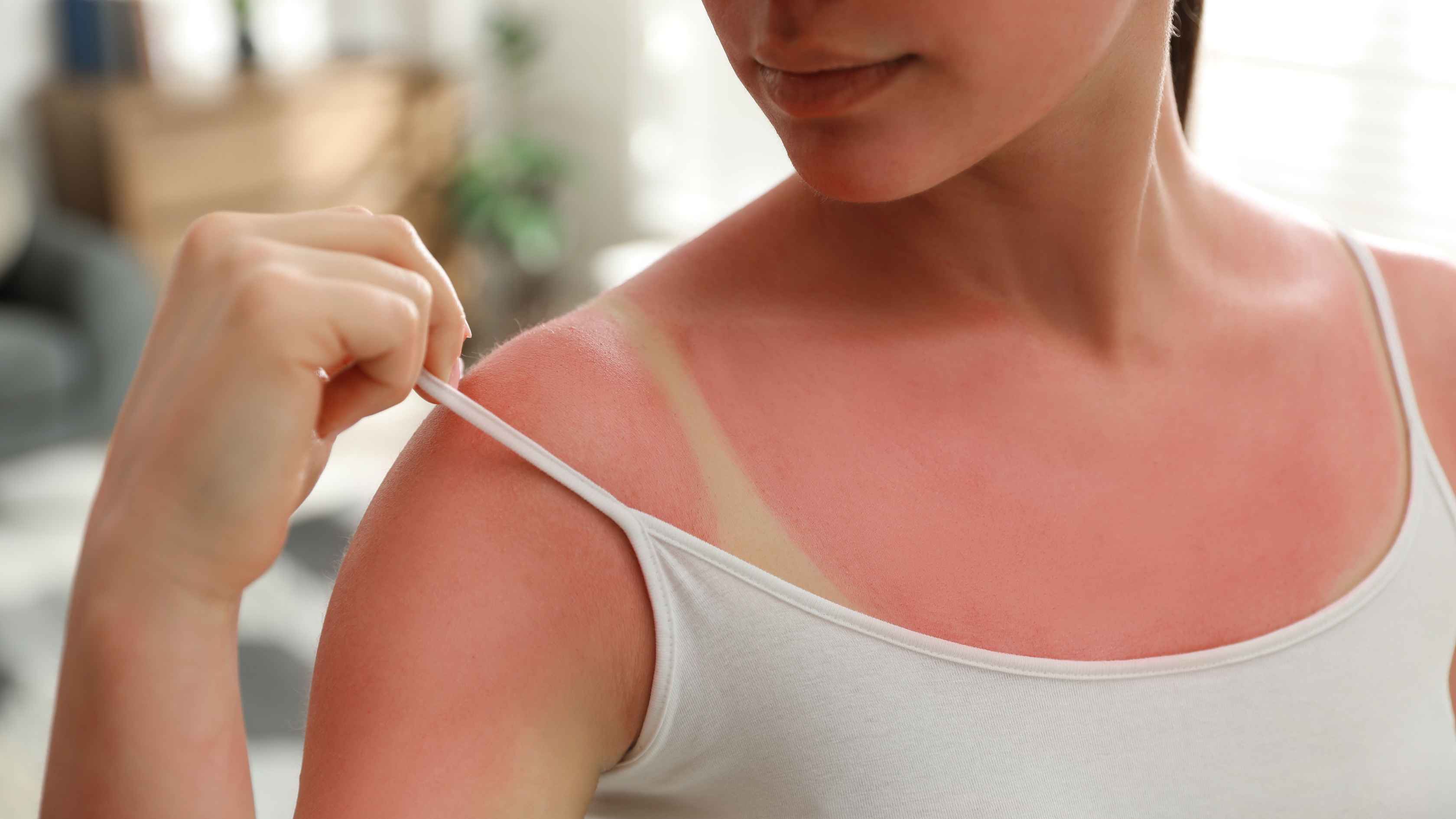 Relieves sunburn