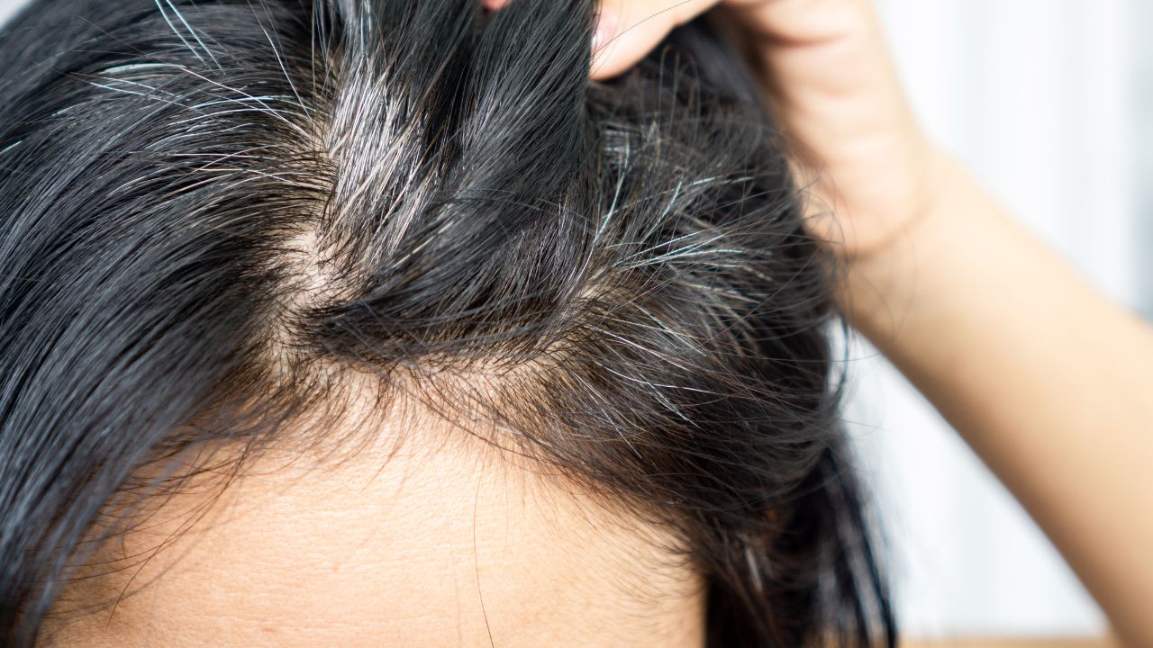 premature greying