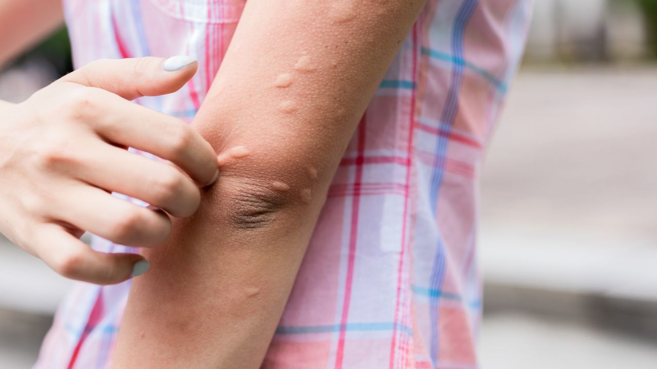 - Prevents insect bites