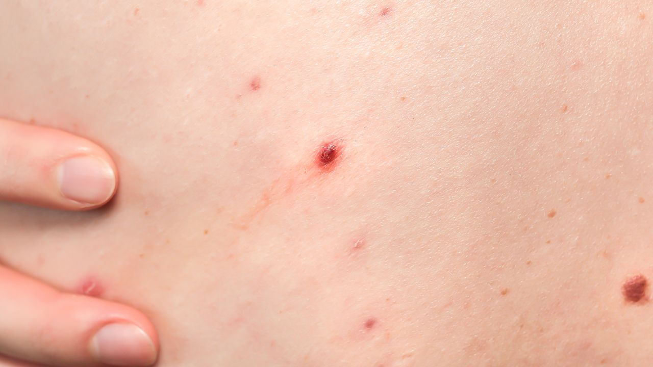 6. Helps reduce acne