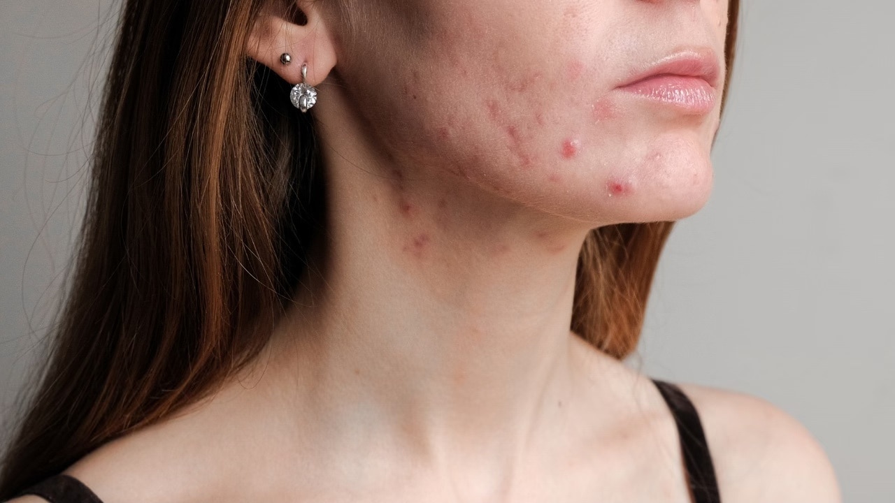 Be wary of acne