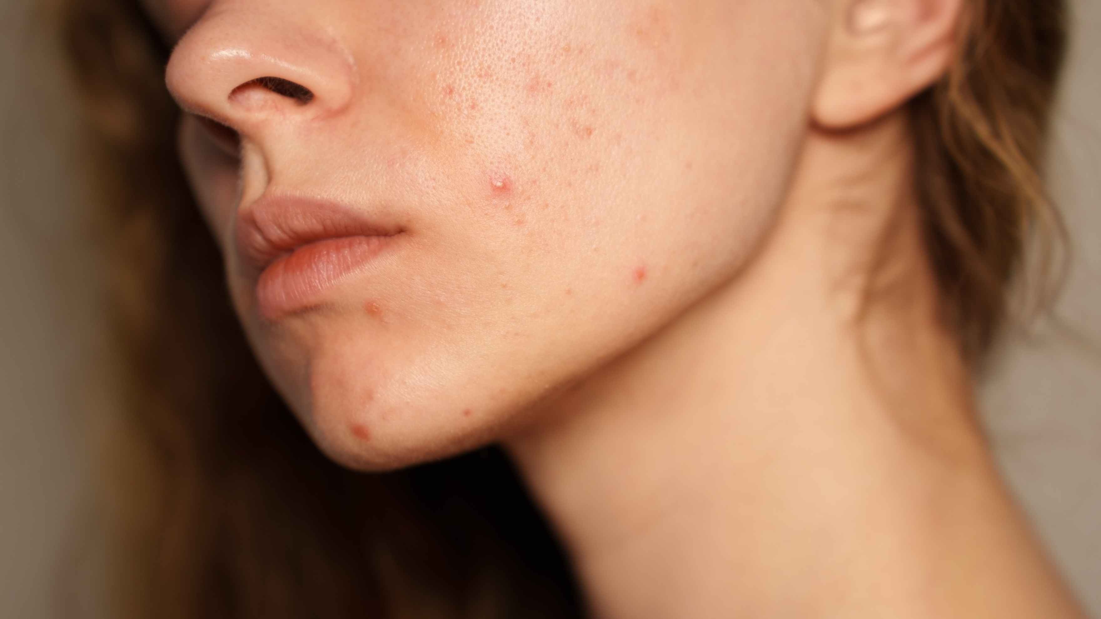 Can Swimming Cause Acne