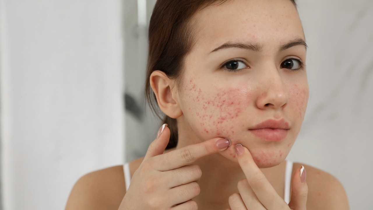 Combats acne