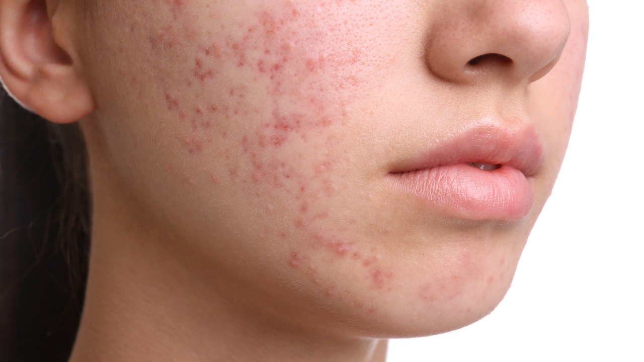 FAQs about doxycycline for acne