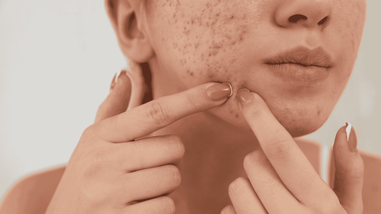 Fights Acne