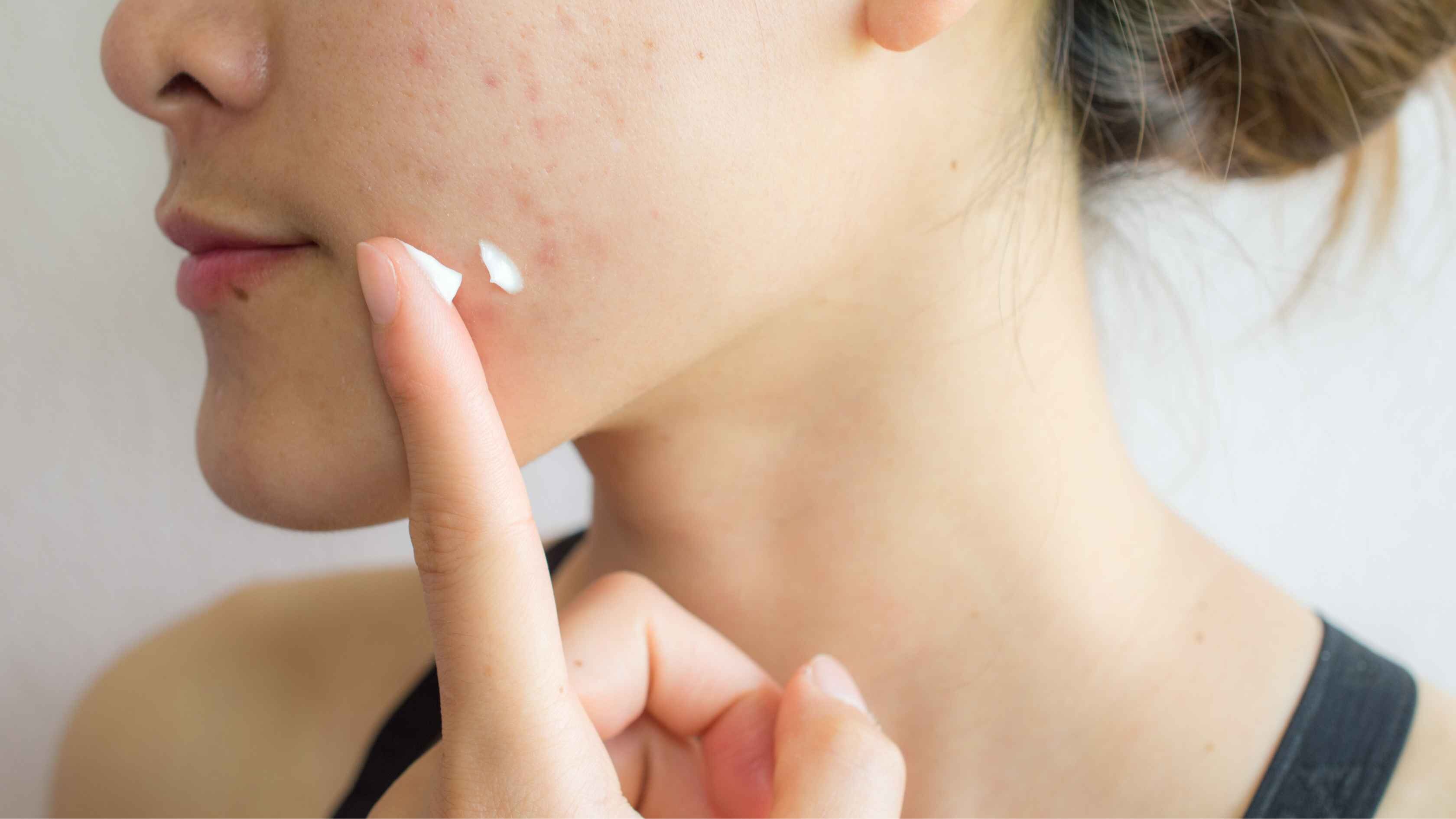 How does benzoyl peroxide work?