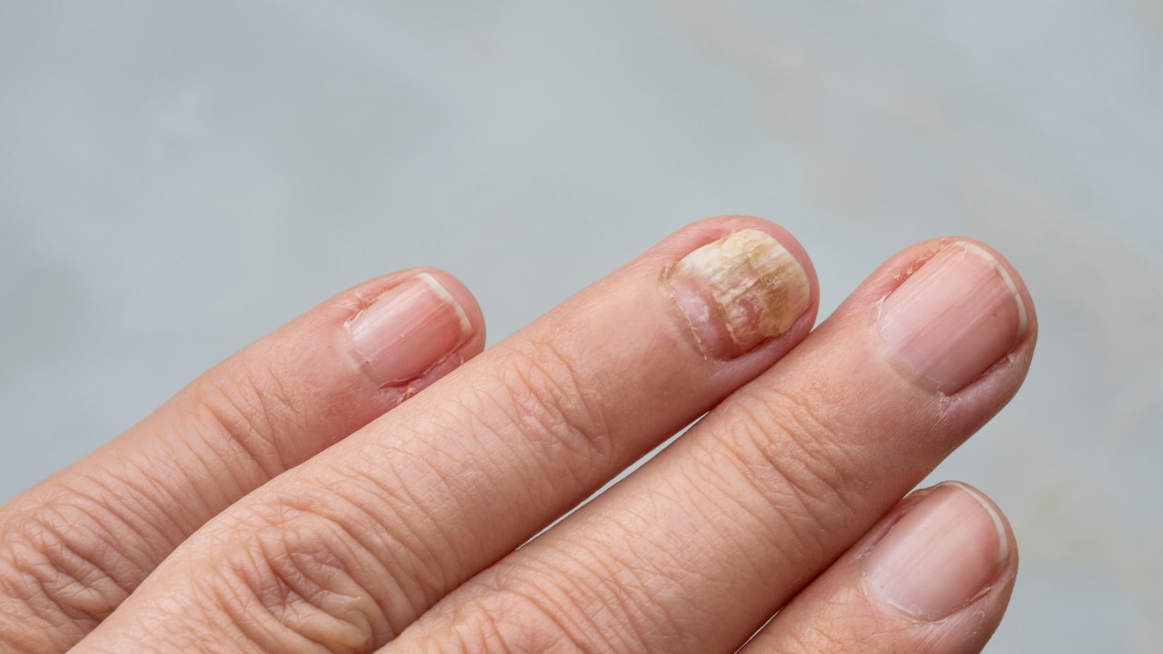 How to Prevent Fungal Infections?
