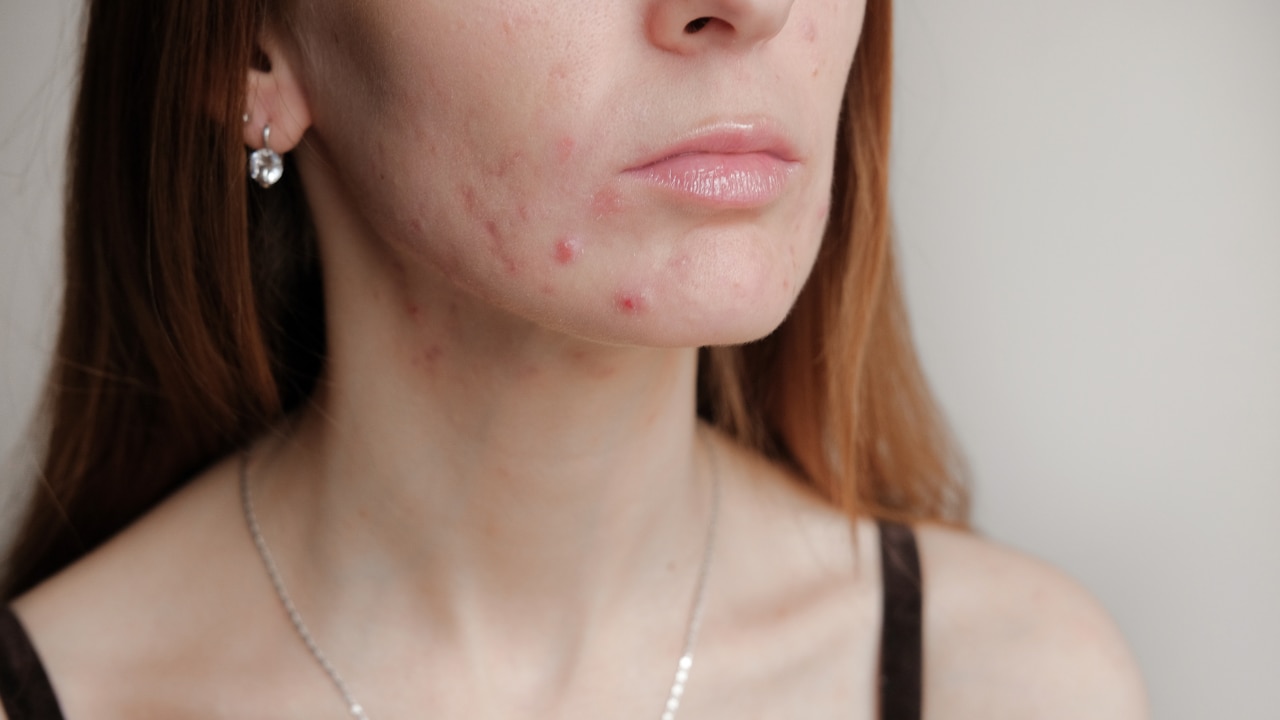How to use doxycycline for acne