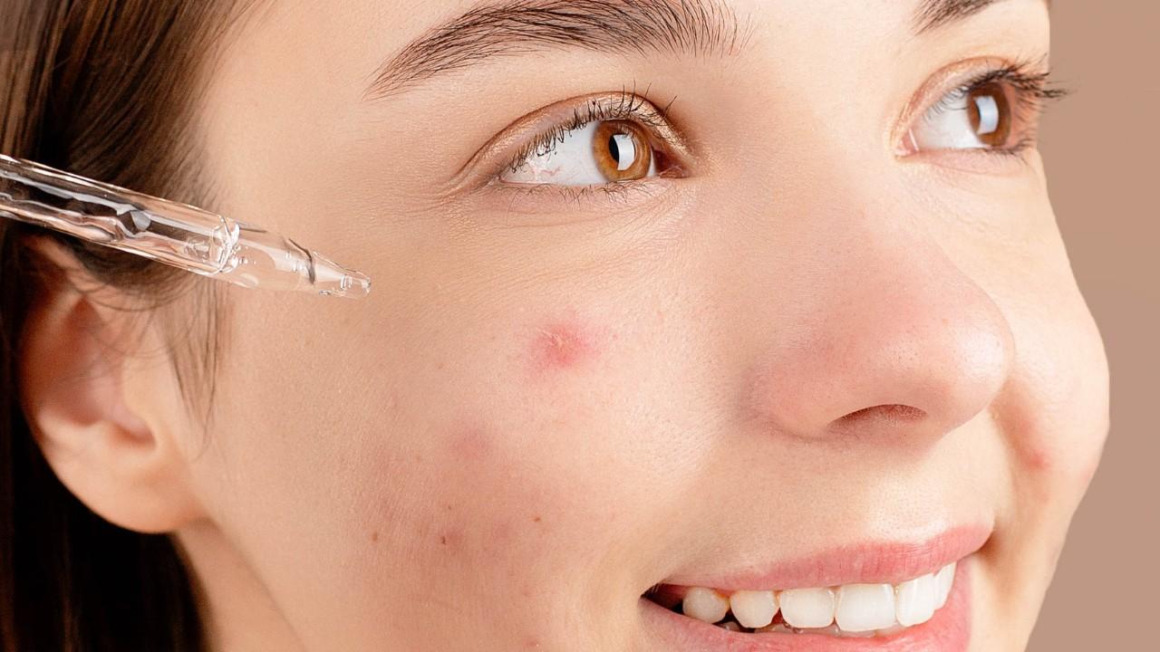 3. It Takes Care Of Acne